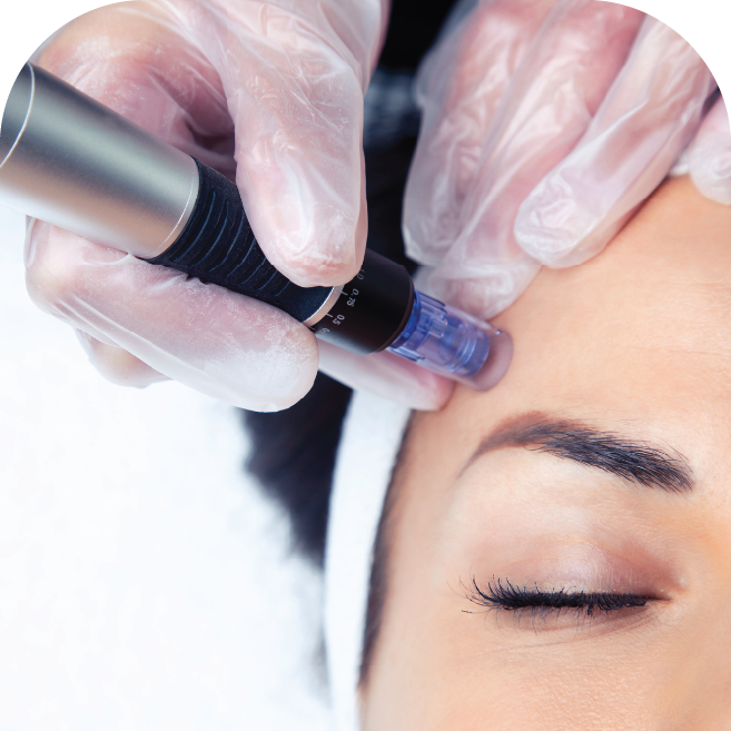 Microneedling_Treatment